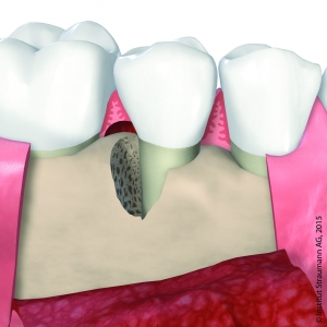 parodontaler Knochendefekt